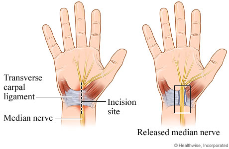 Open Carpal Tunnel Surgery