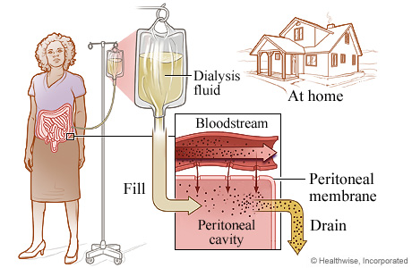 The process of peritoneal dialysis.