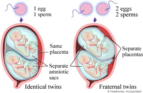Twin pregnancy types