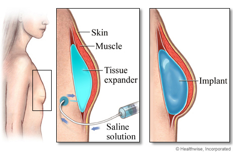 Breast Implant Surgery For Breast Reconstruction Healthlink Bc