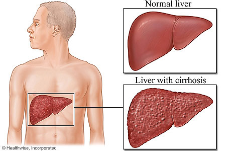 Placement of liver in body with detail of a normal liver and a liver with cirrhosis