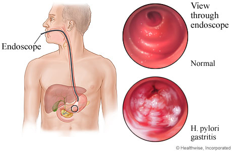 H. pylori gastritis seen through an endoscope.