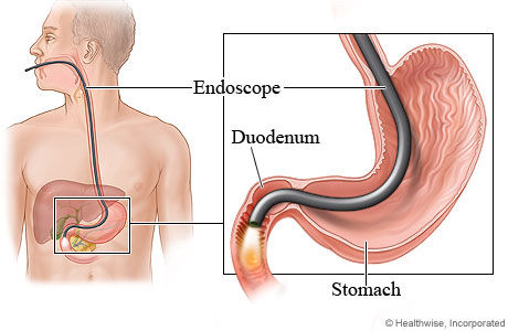 Picture of upper gastrointestinal endoscopy