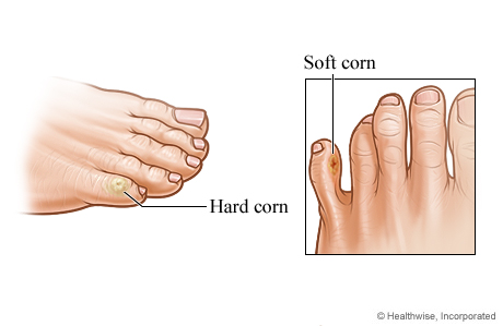 Hard and soft corns on toes