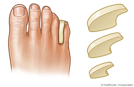 Different sizes of toe separators and one inserted between two toes.