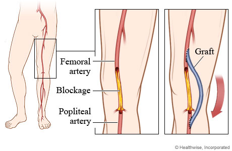 Blocked artery and position of graft in femoropopliteal bypass.