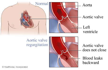 Normal aortic valve and aortic valve regurgitation.