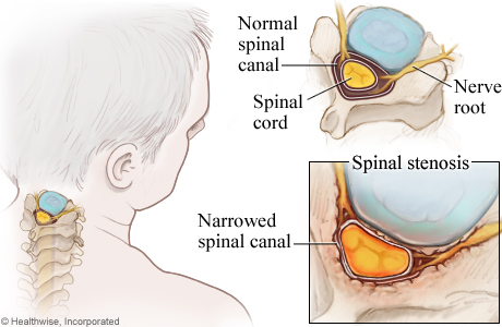 Picture of cervical spinal stenosis.