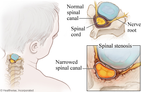 Cervical Spinal Stenosis