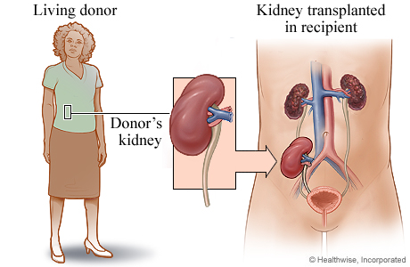 Picture of living-donor kidney transplant