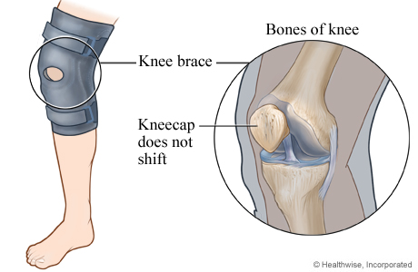 Knee brace to keep the kneecap from shifting