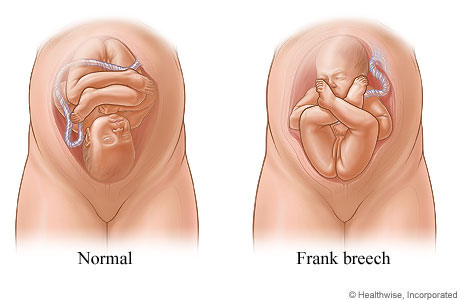 Normal position and frank breech position of fetus