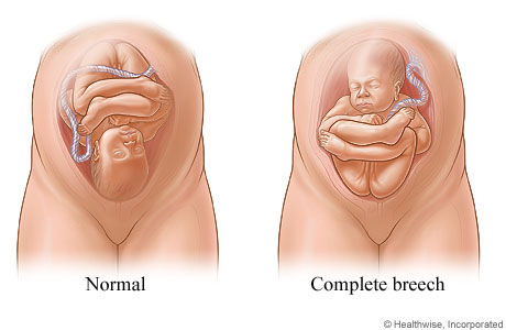 Normal position and complete breech position of fetus