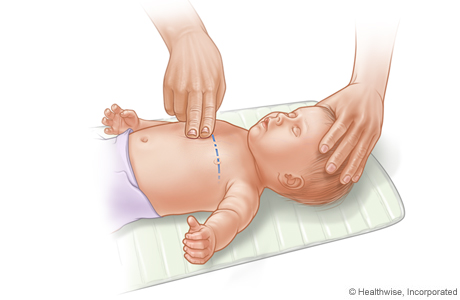 CPR on infant, showing placement of two fingers on breastbone.