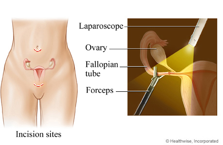 Incision sites for tubal ligation, with detail of the ovary, fallopian tubes, and surgical tools