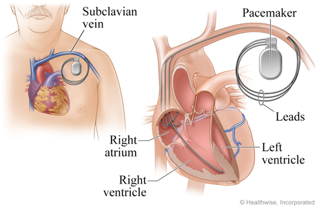 Location of pacemaker and how it connects to the heart
