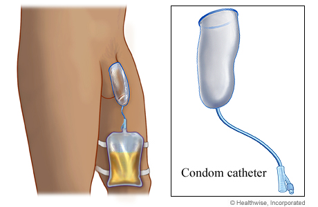 Condom catheter over penis draining urine from catheter to drainage bag secured on leg with straps.