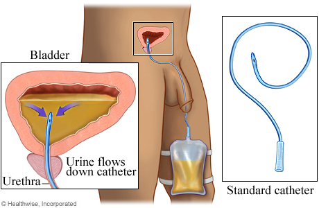 Standard catheter