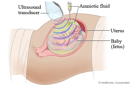 How an amniocentesis is done.