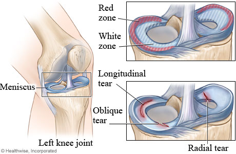 Meniscus healing zones and types of meniscus tears.