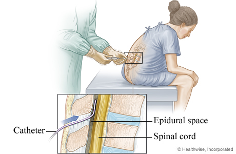 Placement of an epidural catheter for labour