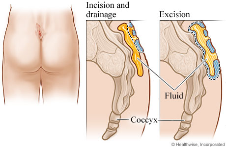 Location of pilonidal cyst with details of incision and excision