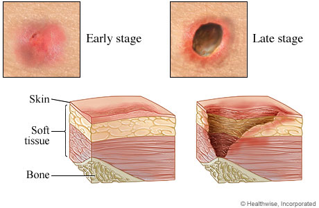 Early-stage and late-stage pressure injuries