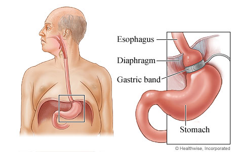 Gastric banding.