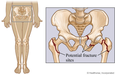Potential pelvic and hip fracture sites