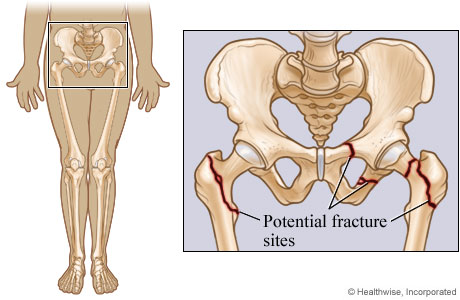 Potential pelvic and hip fracture sites.