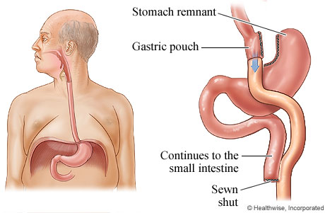 Gastric bypass surgery for obesity