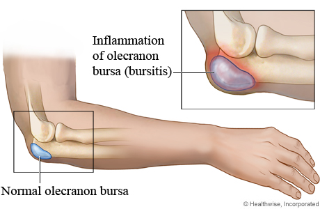 A normal bursa in the elbow compared to an inflamed one (bursitis)