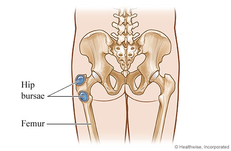 Bursitis of the hip.
