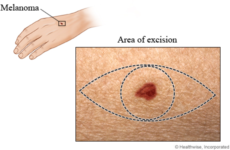 Area of excision for melanoma.