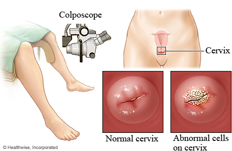 Colposcope and cervix