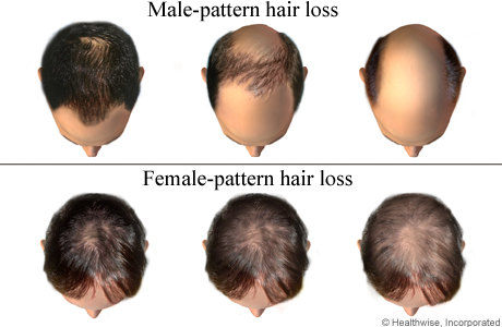 What Causes Hair Loss in Men and How to Treat it