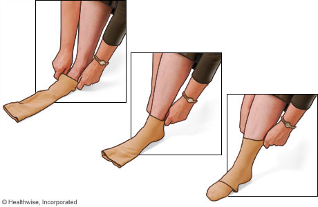 Picture of how to put on compression stockings: Step 3
