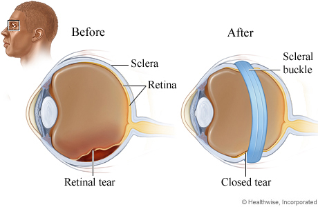 A retinal tear and a scleral buckle.
