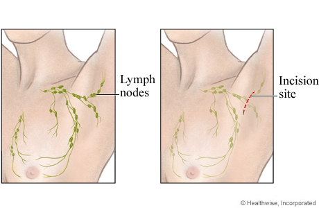 Location for an open lymph node biopsy