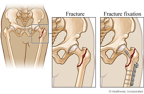 Hip repair for a hip fracture.