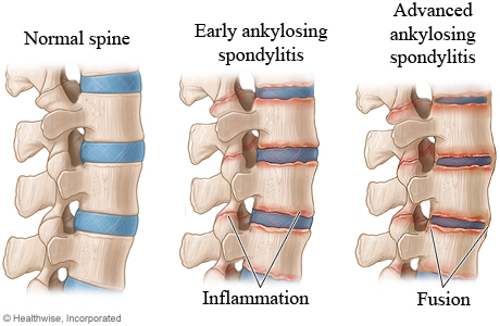 The stages of ankylosing spondylitis in the spine