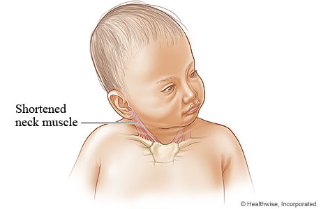 An infant with congenital torticollis