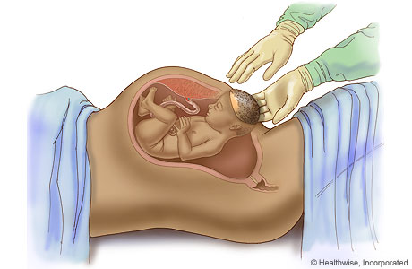 Caesarean delivery