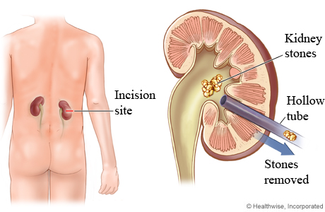 How nephrolithotomy removes kidney stones