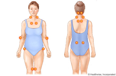 Fibromyalgia tender points.