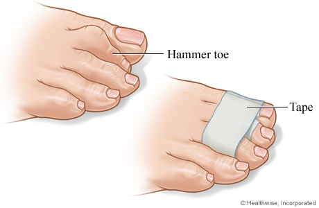 A wrapped hammer toe.