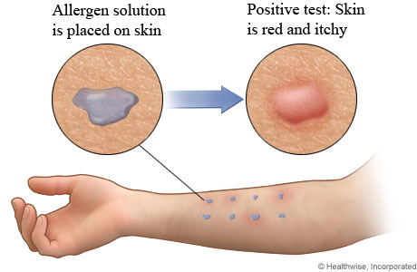 Allergen solution on arm and positive test