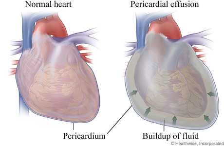 Normal heart and heart with pericardial effusion