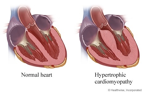 Inside views of normal heart and of heart with thicker walls from hypertrophic cardiomyopathy