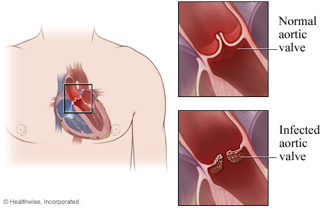 The heart with detail of a normal aortic valve and an infected aortic valve.